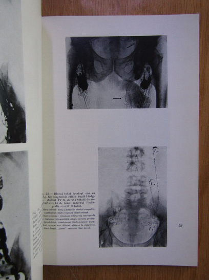H. Bujar - Practica limfografica in clinica