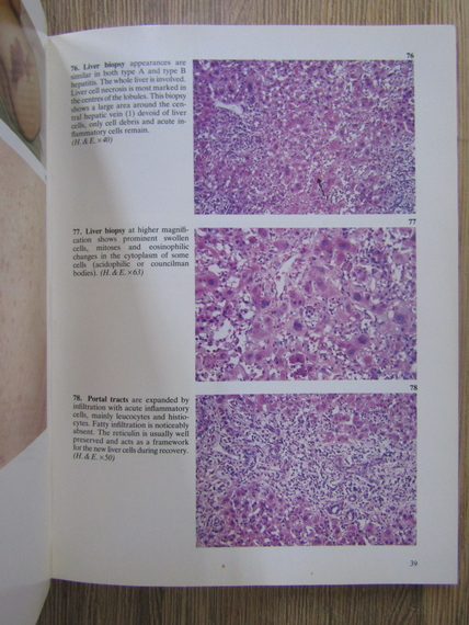 Sheila Sherlock - Color atlas of liver disease
