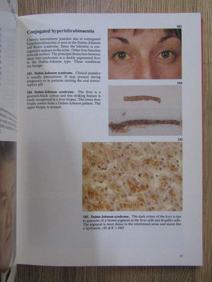 Sheila Sherlock - Color atlas of liver disease