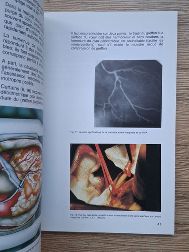 Ph. Gorny - L'etat actuael de la chirurgie coronorarienne